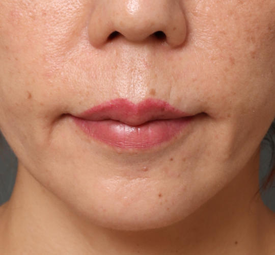 40代女性のヒアルロン酸注射（唇） Before 症例写真