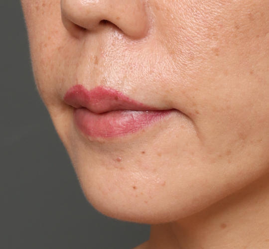 40代女性のヒアルロン酸注射（唇） Before 症例写真