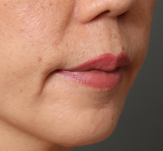 40代女性のヒアルロン酸注射（唇） Before 症例写真