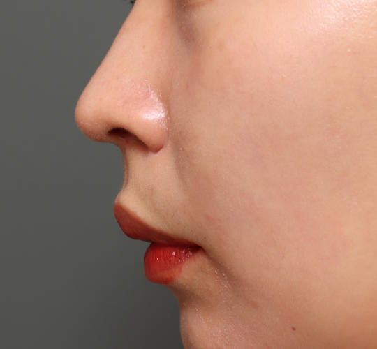 20代女性の鼻の整形 After 症例写真