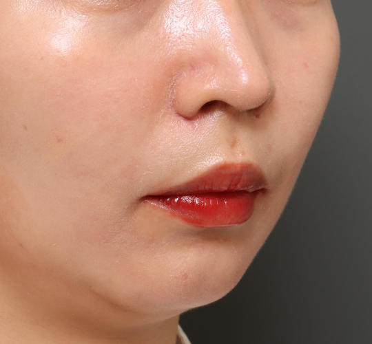 20代女性の耳介軟骨移植 After 症例写真