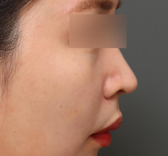 20代女性の耳介軟骨移植 After 症例写真