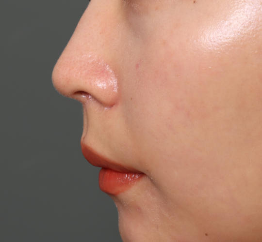 20代女性の鼻の整形 Before 症例写真
