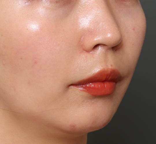 20代女性の耳介軟骨移植 Before 症例写真