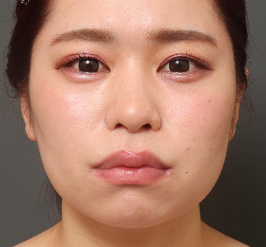 20代女性の顔の脂肪吸引  Before 症例写真