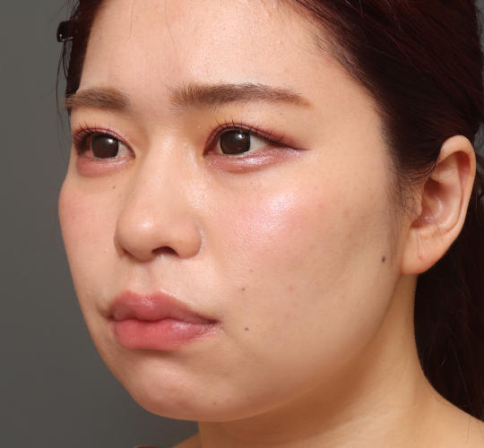 20代女性のVOVリフトプレミアム Before 症例写真