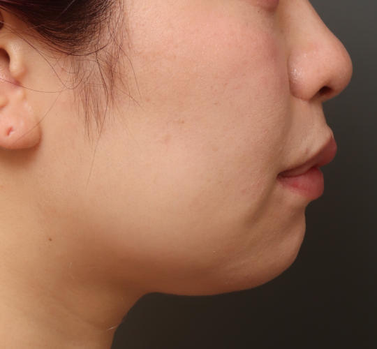 20代女性の顔の脂肪吸引  Before 症例写真