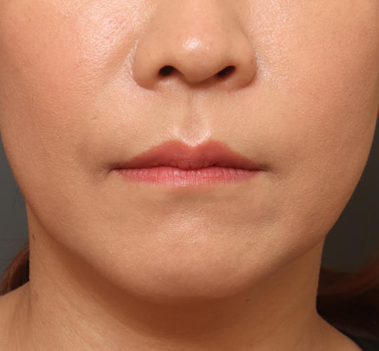 40代女性の人中短縮ボトックス After 症例写真