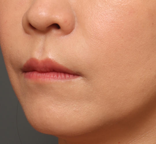 40代女性の人中短縮ボトックス After 症例写真