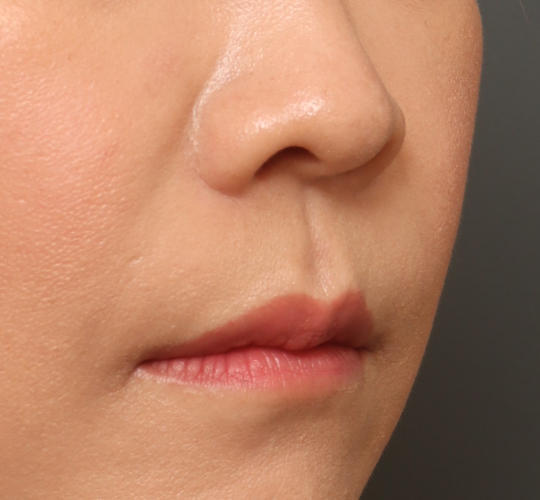 40代女性の人中短縮ボトックス After 症例写真