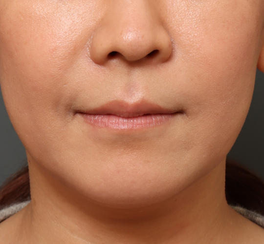 40代女性の人中短縮ボトックス Before 症例写真