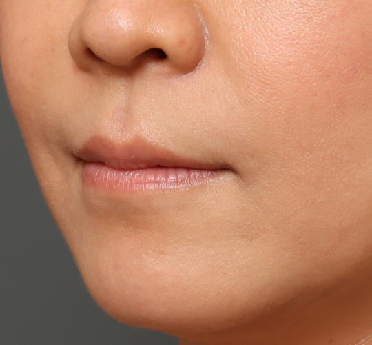 40代女性の人中短縮ボトックス Before 症例写真