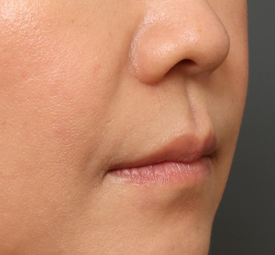 40代女性の人中短縮ボトックス Before 症例写真