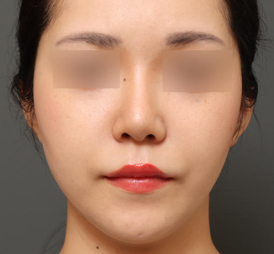 20代女性の鼻中隔延長 Before 症例写真