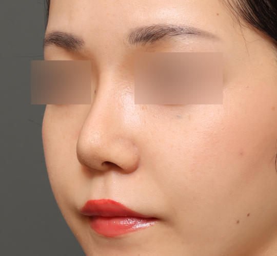 20代女性の鼻中隔延長 Before 症例写真