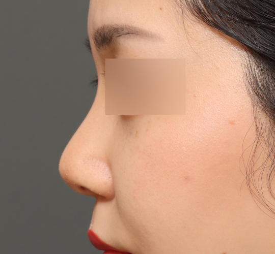 20代女性の鼻中隔延長 Before 症例写真