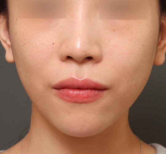 30代女性のヒアルロン酸注射(目の下) After 症例写真