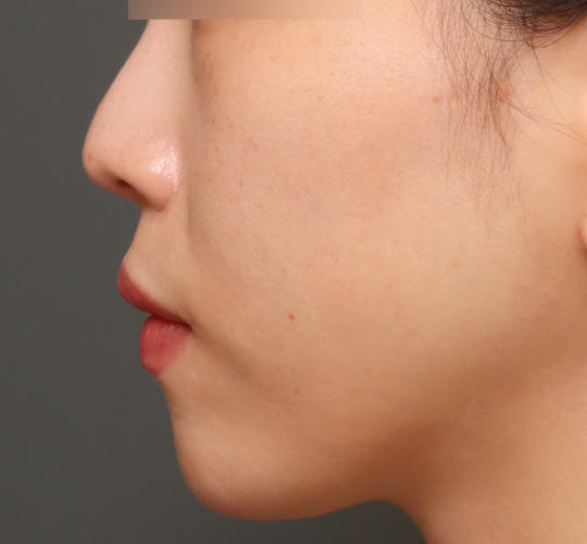 30代女性の人中短縮ボトックス After 症例写真