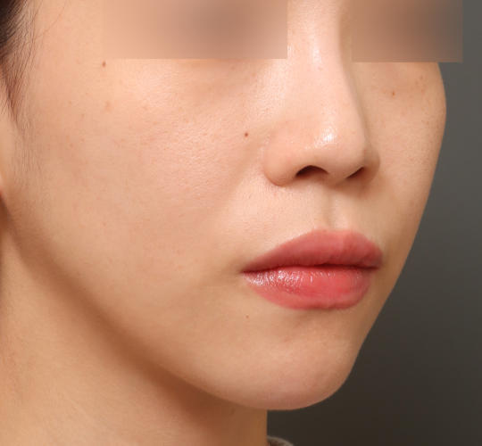 30代女性の人中短縮ボトックス After 症例写真