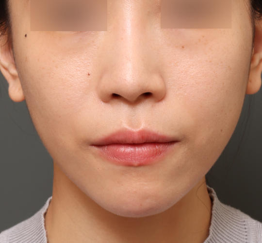 30代女性のヒアルロン酸注射(目の下) Before 症例写真