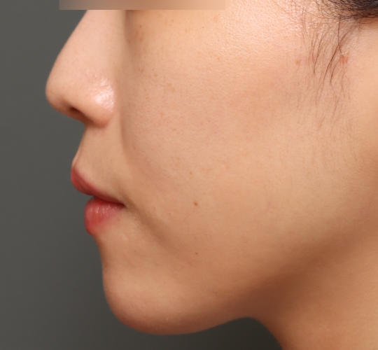 30代女性の人中短縮ボトックス Before 症例写真