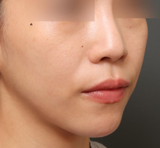 30代女性の人中短縮ボトックス Before 症例写真