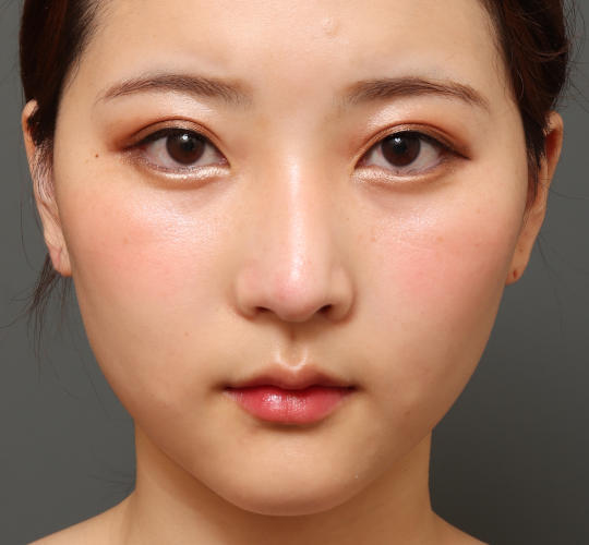 20代女性の二重整形・目元の整形 Before 症例写真