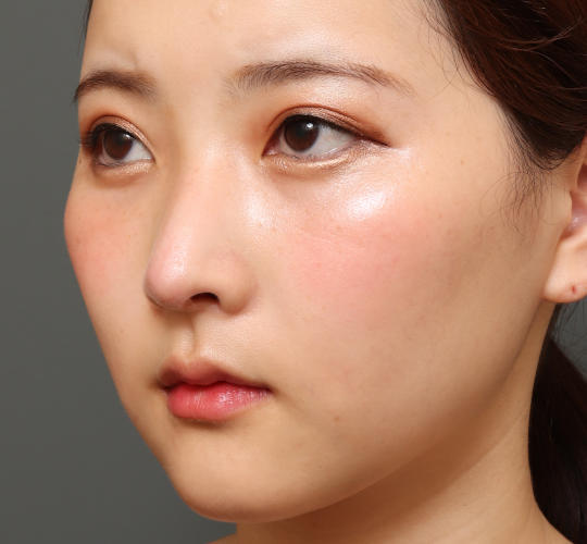 20代女性の目つき矯正 Before 症例写真