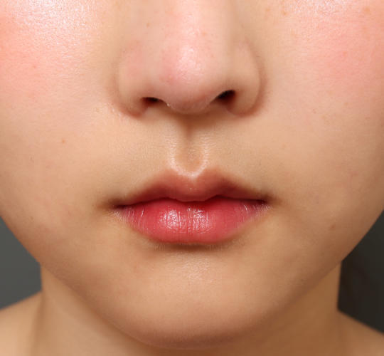 20代女性の目つき矯正 Before 症例写真