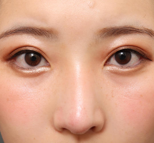 20代女性の目つき矯正 Before 症例写真