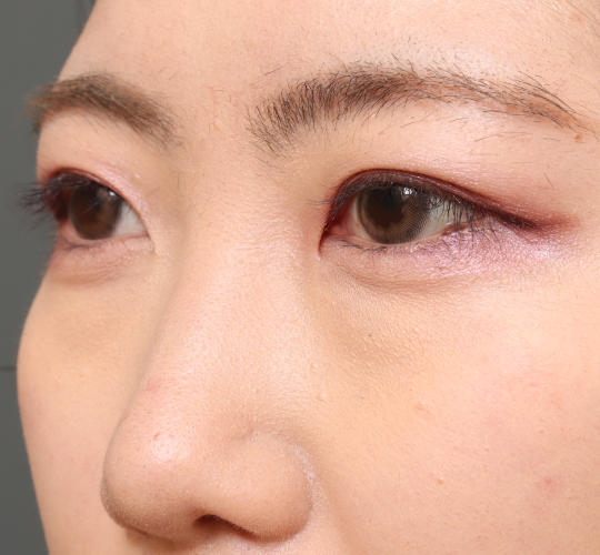 20代女性の目つき矯正 Before 症例写真