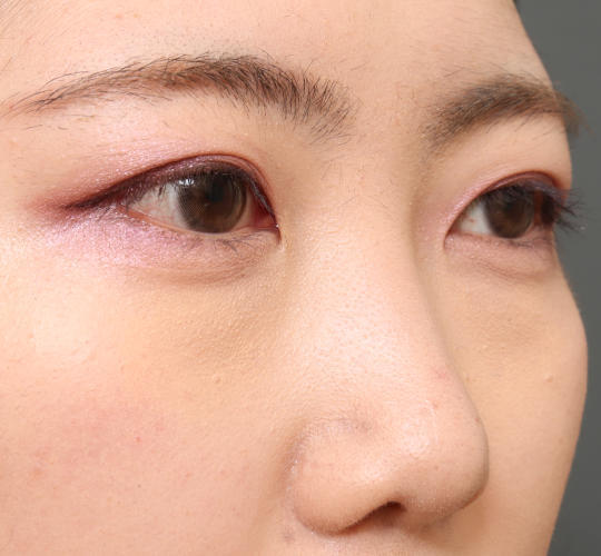 20代女性の目つき矯正 Before 症例写真