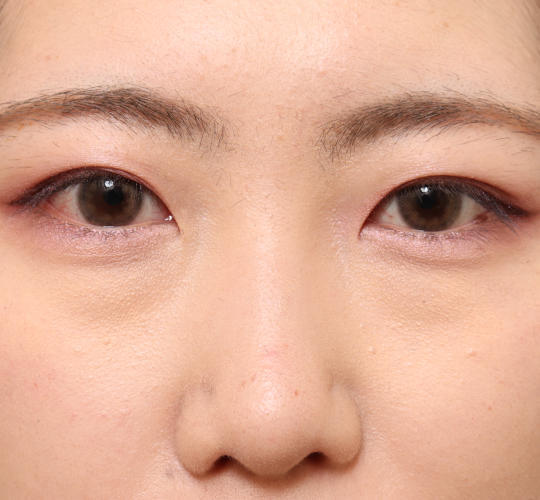 20代女性の目つき矯正 Before 症例写真