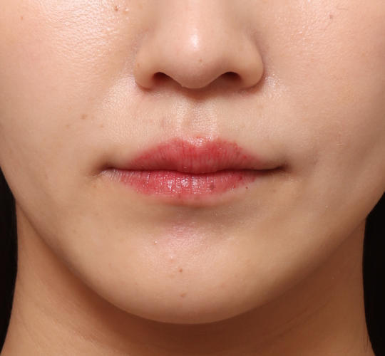 20代女性の人中短縮ボトックス After 症例写真