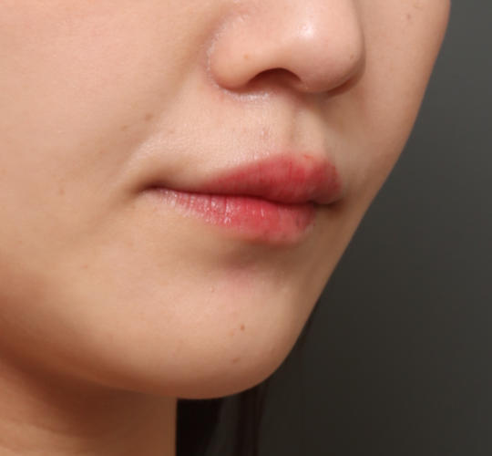 20代女性の人中短縮ボトックス After 症例写真