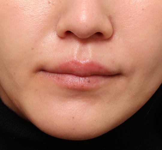 20代女性の人中短縮ボトックス Before 症例写真