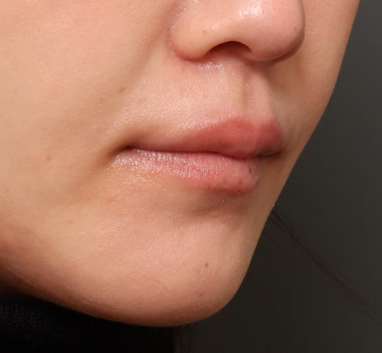 20代女性の人中短縮ボトックス Before 症例写真