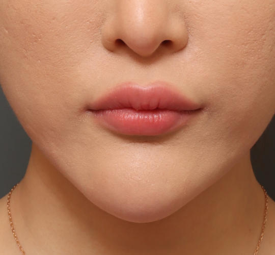 20代女性の唇・口元の整形 After 症例写真
