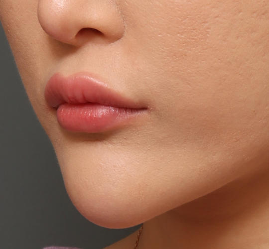 20代女性の人中短縮ボトックス After 症例写真