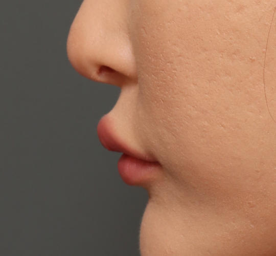 20代女性の人中短縮ボトックス After 症例写真