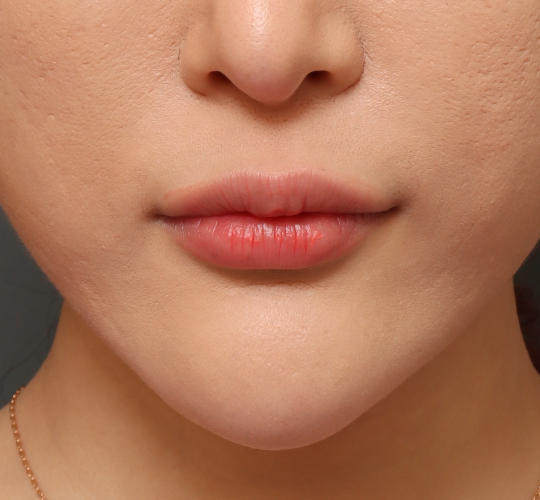 20代女性の唇・口元の整形 Before 症例写真
