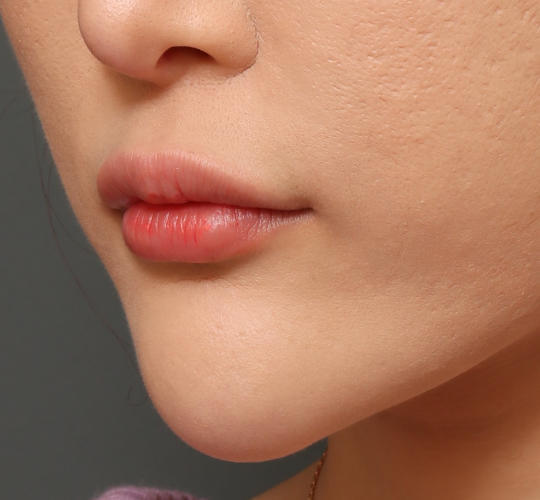 20代女性の人中短縮ボトックス Before 症例写真