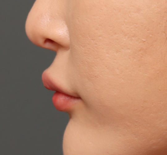 20代女性の人中短縮ボトックス Before 症例写真