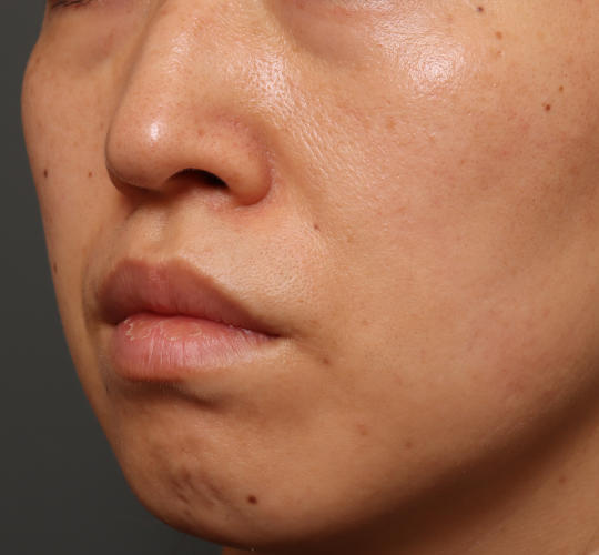 30代女性のリバースピール After 症例写真