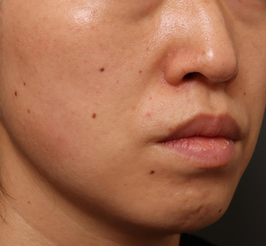 30代女性のリバースピール After 症例写真