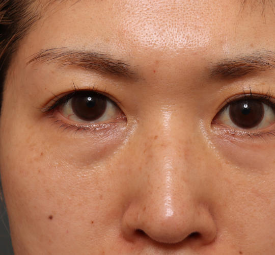 30代女性のリバースピール After 症例写真