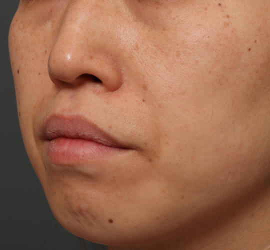 30代女性のリバースピール Before 症例写真