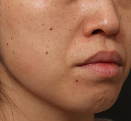 30代女性のリバースピール Before 症例写真