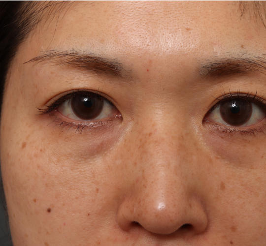 30代女性のリバースピール Before 症例写真