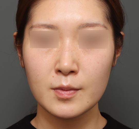 20代女性の顔の脂肪吸引  After 症例写真